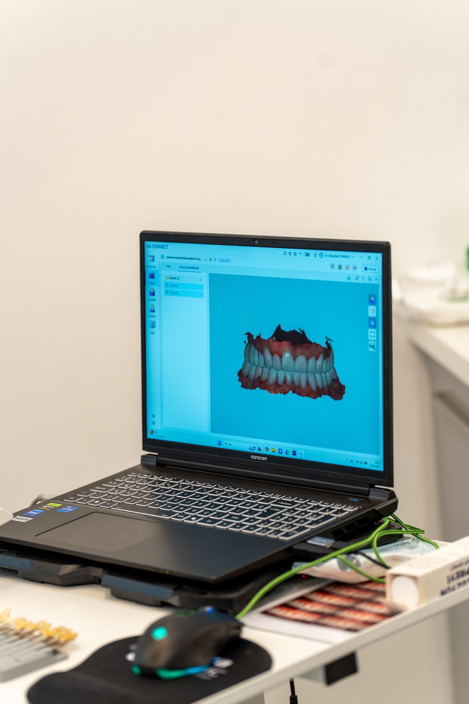 A digital model of teeth on a laptop screen.