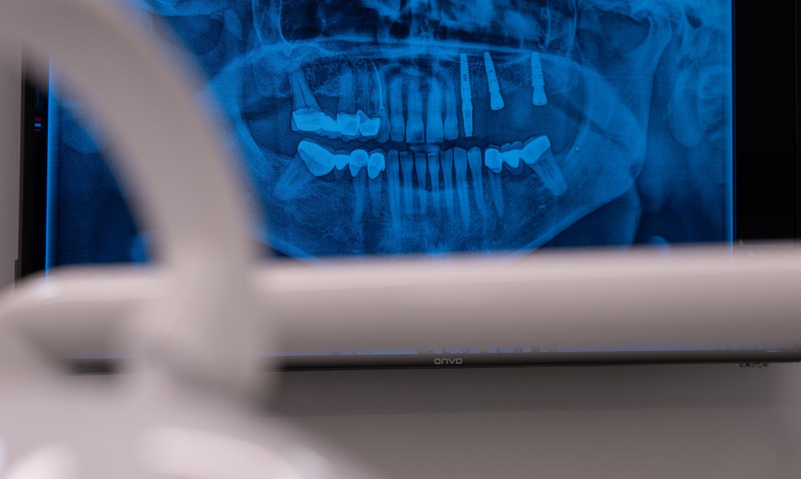 A panoramic dental X-ray with implants, on a screen in the clinic.