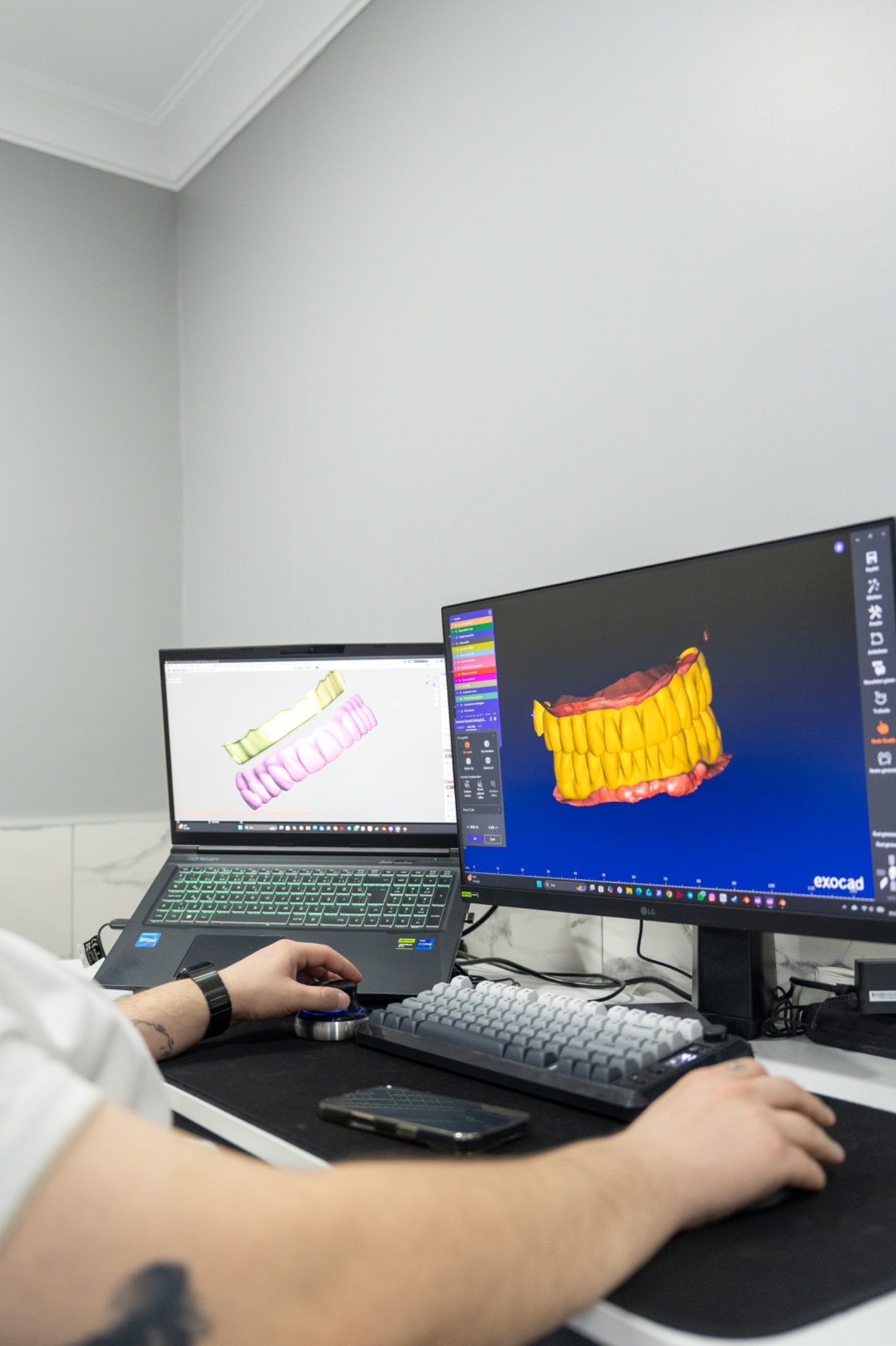 A digital dental model on a monitor, beside a laptop.